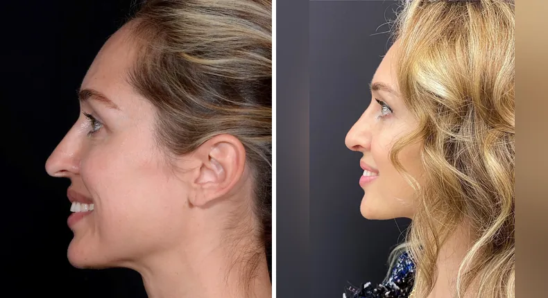 Before and after rhinoplasty: patient's nose from the left side