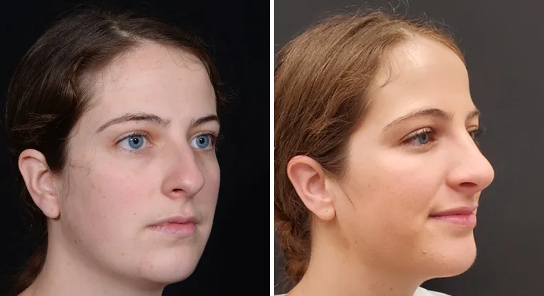 Before and after rhinoplasty: patient's nose at a right angle