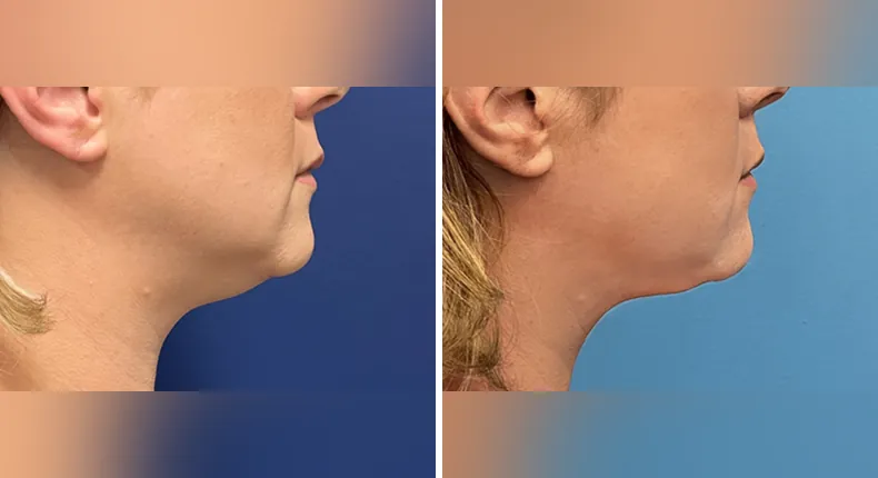 Before and after submental liposuction: woman's neck and chin from the right side