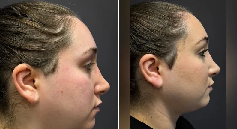 Before and after submental liposuction: patient's neck and chin from the right side
