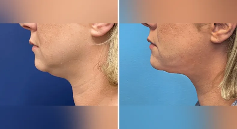 Before and after submental liposuction: woman's neck and chin from the left side