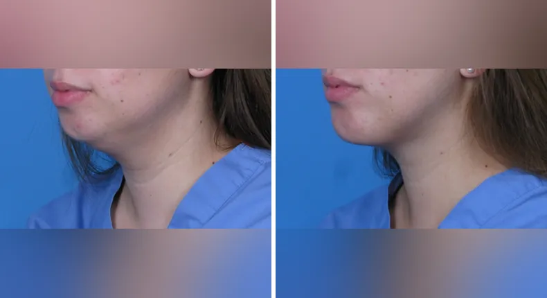 Before and after submental liposuction: patient's neck and chin at a left angle