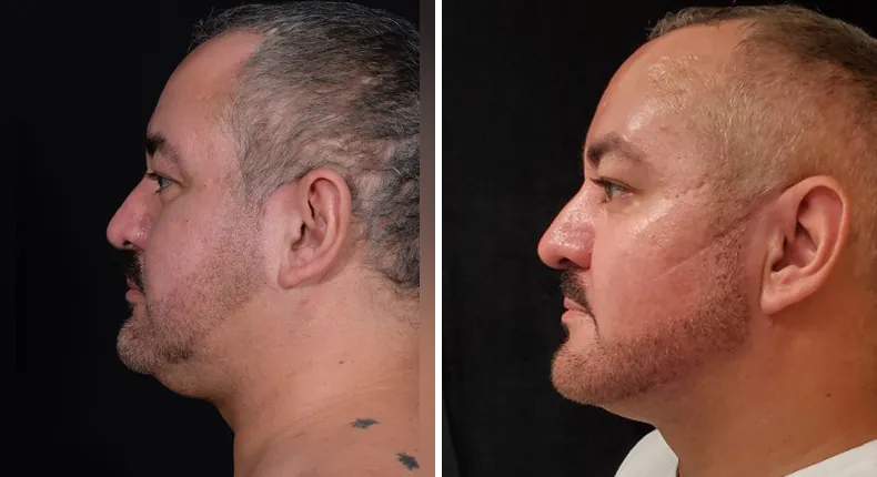 Before and after submental liposuction: patient's neck and chin from the left side