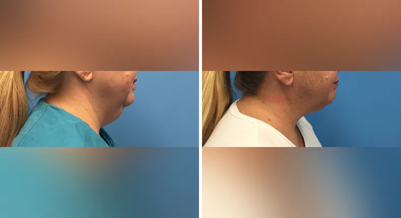 Before and after submental liposuction: woman's neck and chin