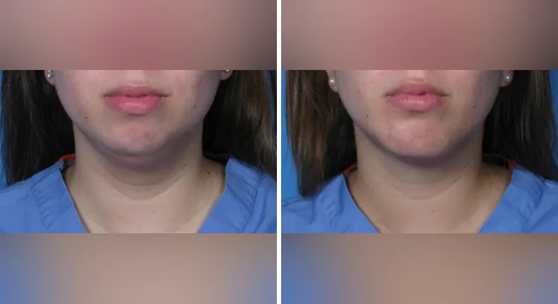 Before and after submental liposuction: patient's neck and chin from the front