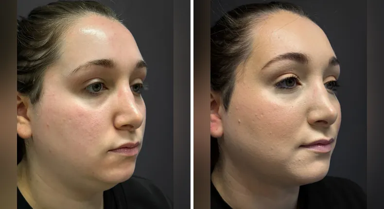 Before and after submental liposuction: patient's neck and chin at a right angle