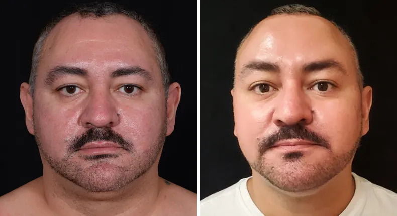 Before and after submental liposuction: patient's neck and chin from the front