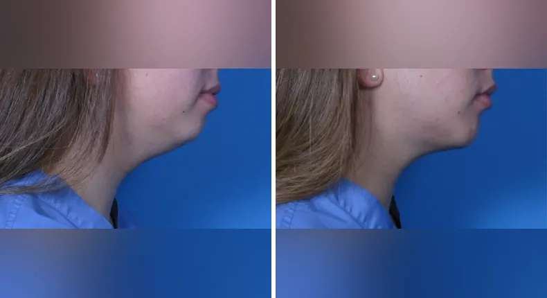 Before and after submental liposuction: patient's neck and chin from the right side