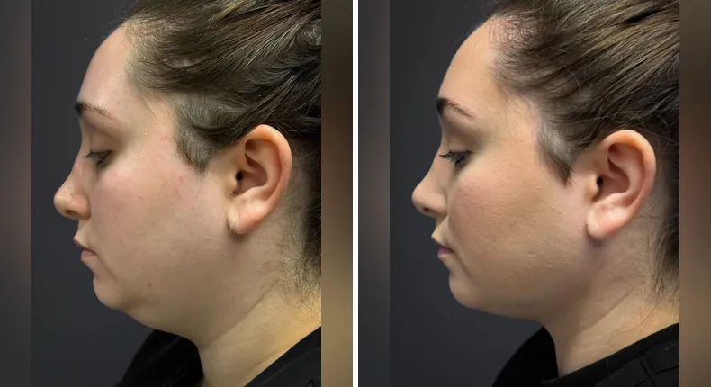 Before and after submental liposuction: patient's neck and chin from the left side