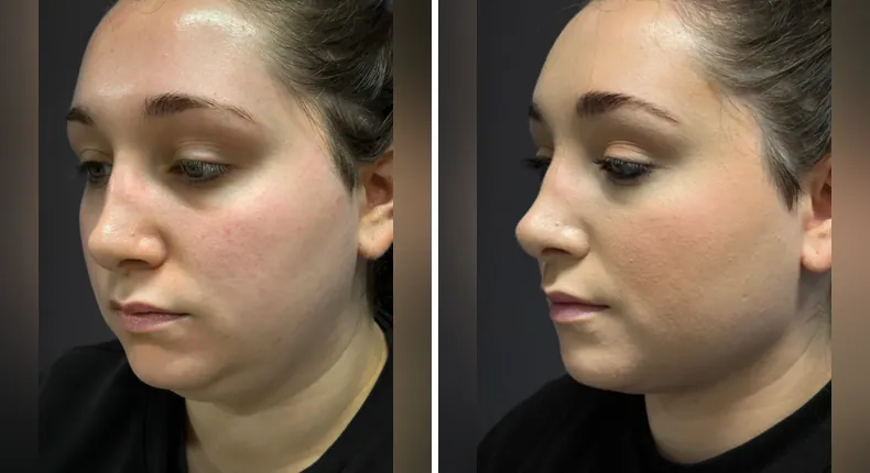 Before and after submental liposuction: patient's neck and chin at a left angle