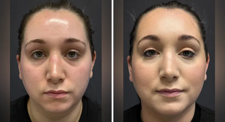 Before and after submental liposuction: patient's neck and chin from the front