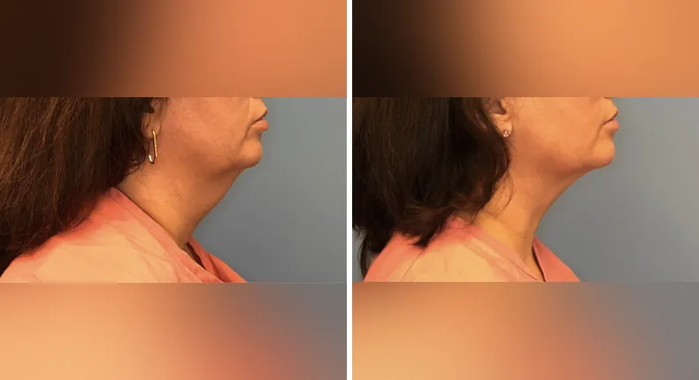 Before and after submental liposuction: woman's neck and chin