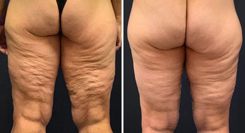 Before and after thigh lift: patient's thighs from the back