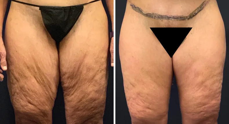 Before and after thigh lift: patient's thighs from the front