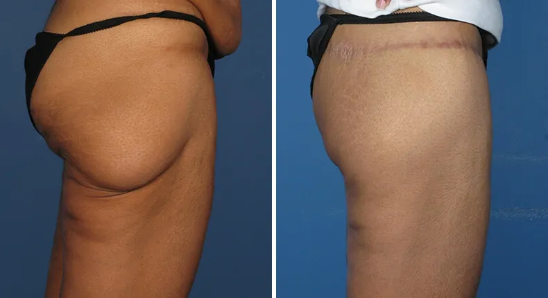 Before and after thigh lift: patient's thighs in right profile