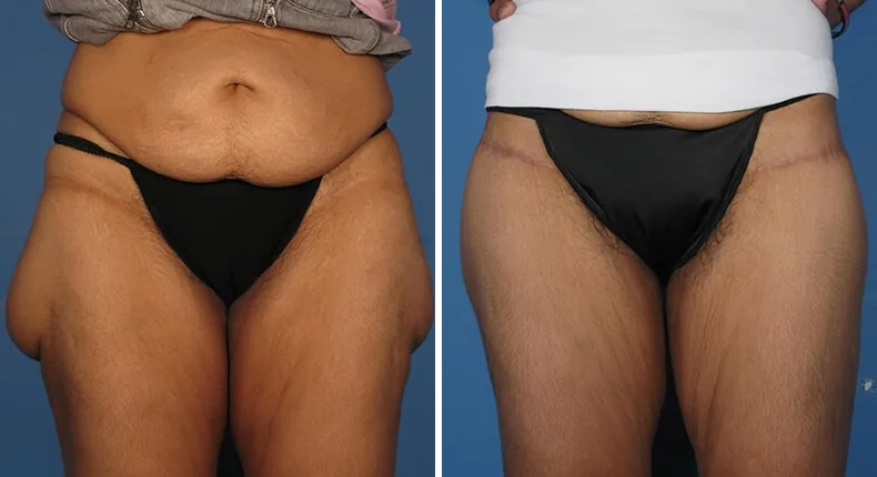 Before and after thigh lift: patient's thighs from the front