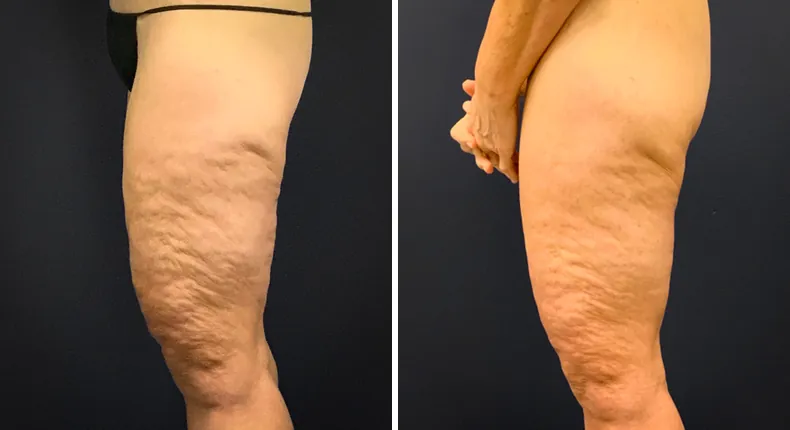 Before and after thigh lift: patient's thighs from the left side