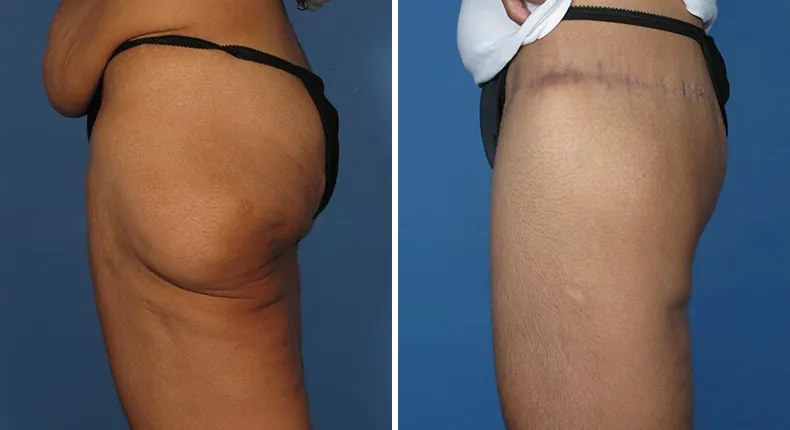Before and after thigh lift: patient's thighs in left profile