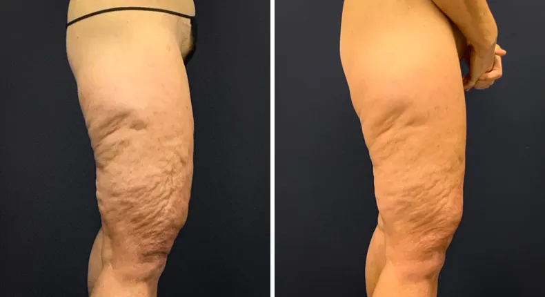 Before and after thigh lift: patient's thighs from the right side