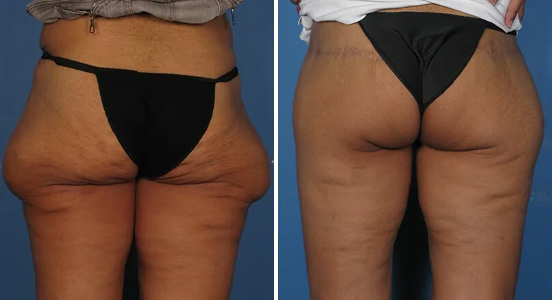 Before and after thigh lift: patient's thighs from the back