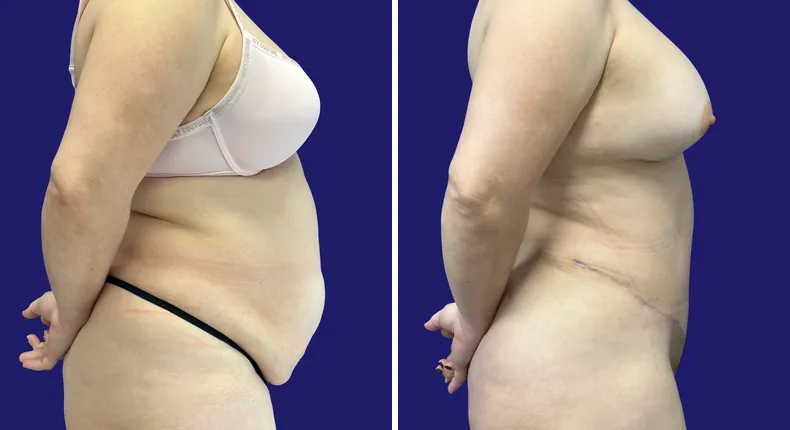Before and after tummy tuck: woman's abdomen, with liposuction, mommy makeover and brazilian butt lift (bbl)