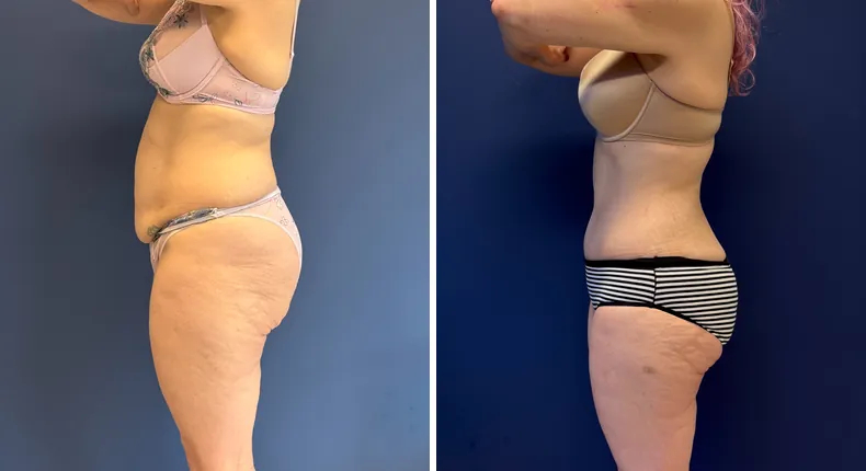 Before and after tummy tuck: patient's abdomen