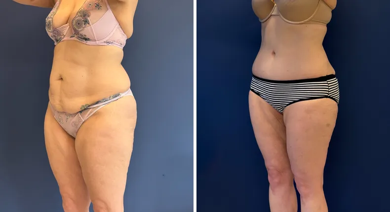 Before and after tummy tuck: patient's abdomen