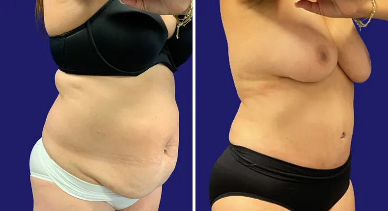 Before and after tummy tuck: woman's abdomen