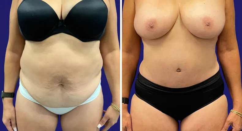 Before and after tummy tuck: woman's abdomen