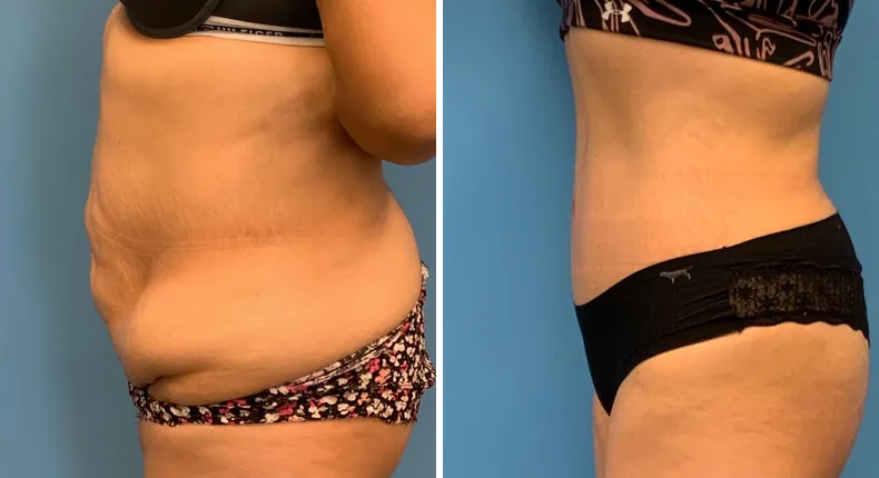 Before and after tummy tuck: patient's abdomen from the left side