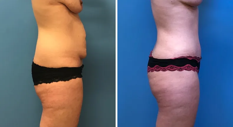 Before and after tummy tuck: woman's abdomen from the right side, with liposuction