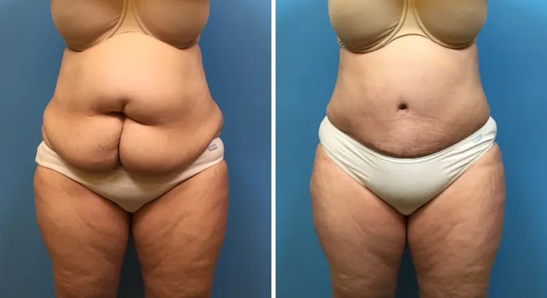 Before and after tummy tuck: woman's abdomen from the front, with liposuction