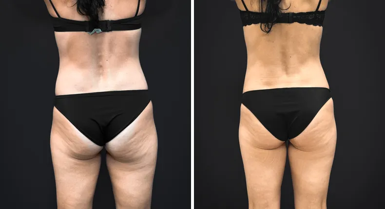 Before and after tummy tuck: patient's abdomen from the back