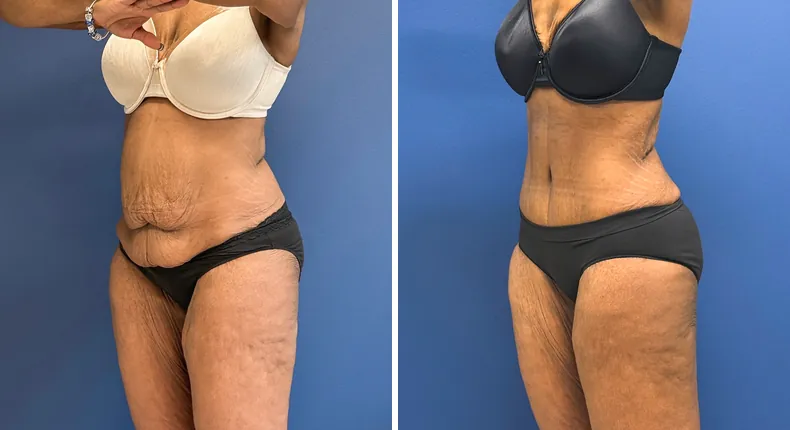 Before and after tummy tuck: patient's abdomen at a left angle