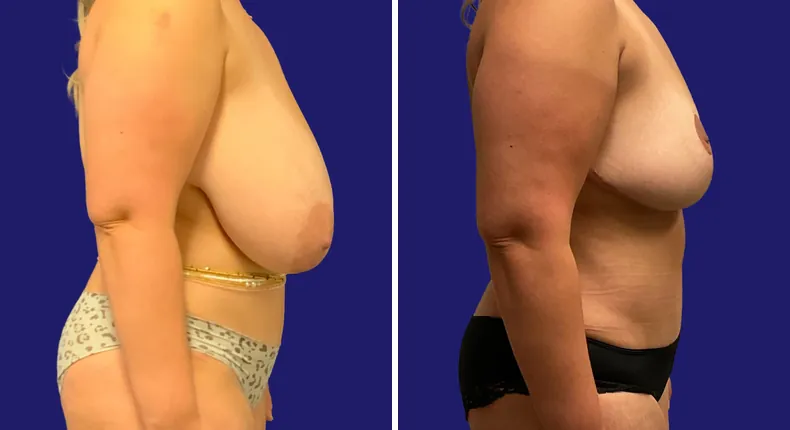 Before and after tummy tuck: woman's abdomen, with breast lift, breast reduction and mommy makeover