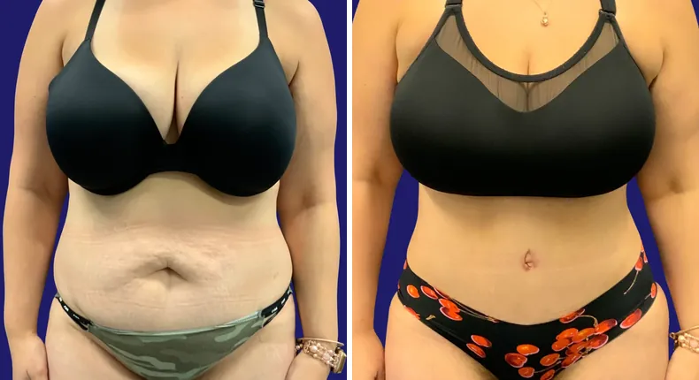 Before and after tummy tuck: woman's abdomen, with breast lift, breast reduction and mommy makeover