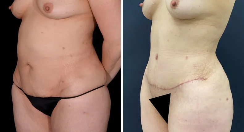 Before and after tummy tuck: patient's abdomen at a left angle, with liposuction