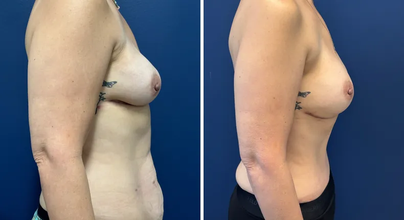 Before and after tummy tuck: patient's abdomen in right profile, with diep flap
