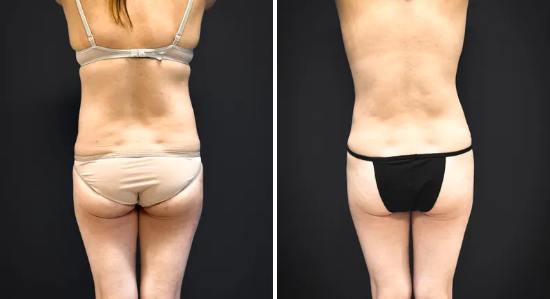 Before and after tummy tuck: patient's abdomen from the back