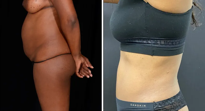 Before and after tummy tuck: patient's abdomen in left profile, with liposuction