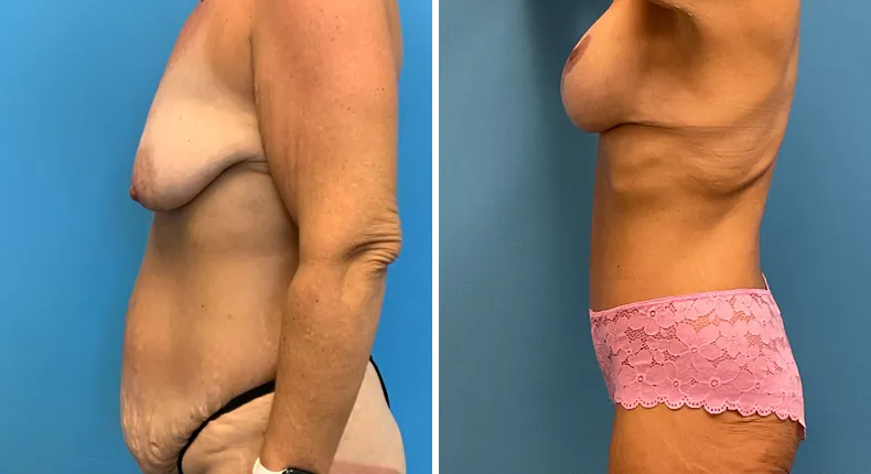 Before and after tummy tuck: patient's abdomen from the left side