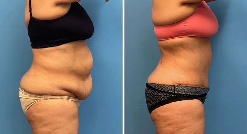 Before and after tummy tuck: patient's abdomen from the right side, with liposuction