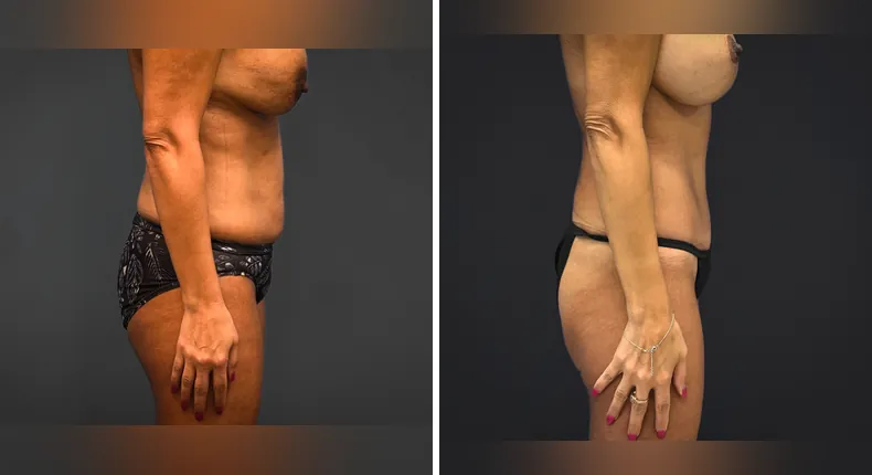 Before and after tummy tuck: patient's abdomen from the right side, with liposuction