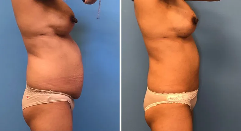 Before and after tummy tuck: woman's abdomen from the right side, with breast reconstruction
