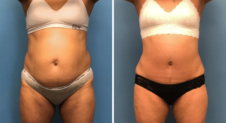 Before and after tummy tuck: woman's abdomen from the front, with liposuction