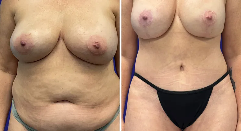 Before and after tummy tuck: woman's abdomen, with breast reconstruction, breast augmentation with lift and liposuction