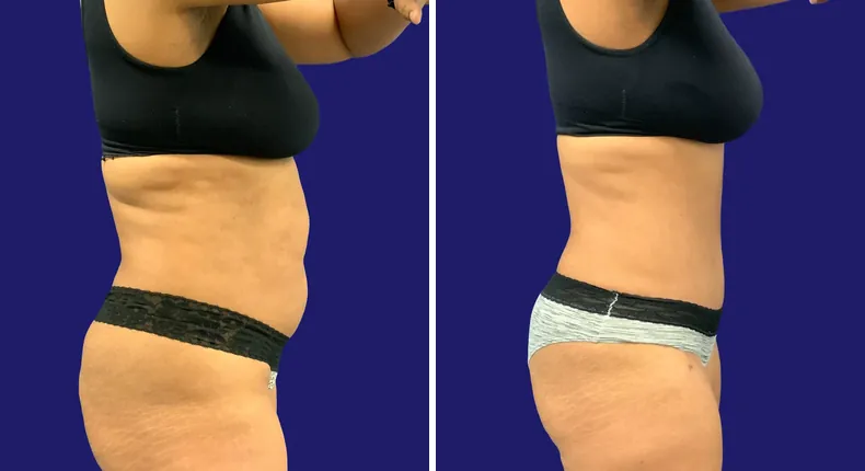Before and after tummy tuck: woman's abdomen, with liposuction