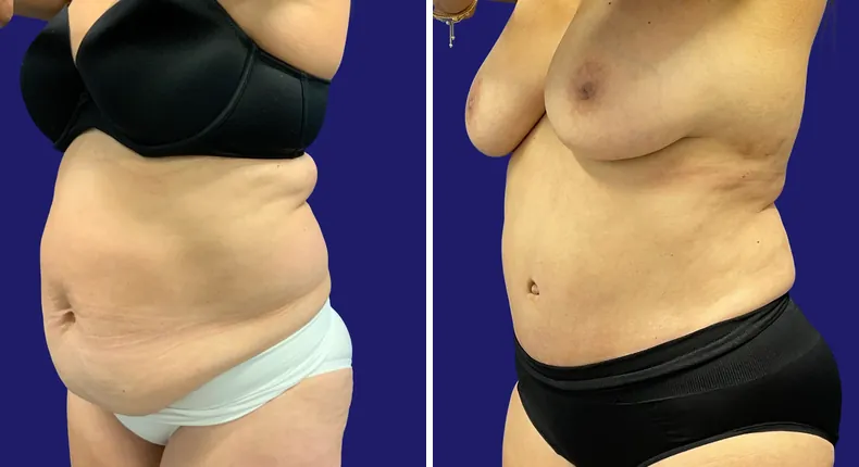 Before and after tummy tuck: woman's abdomen