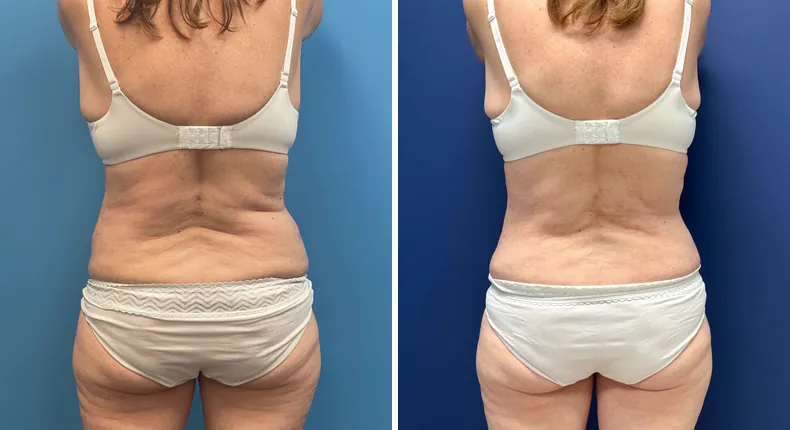 Before and after tummy tuck: patient's abdomen from the back, with liposuction