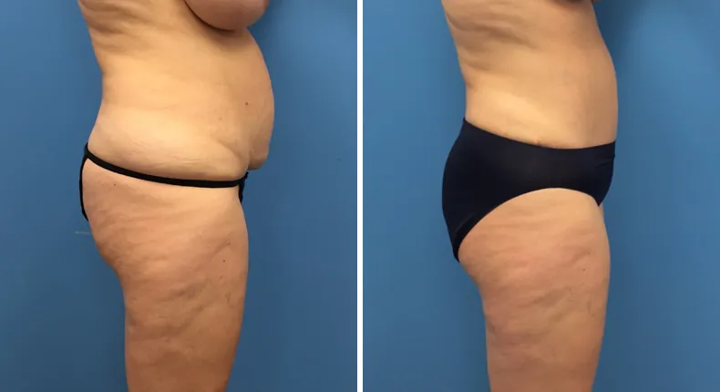 Before and after tummy tuck: patient's abdomen from the right side, with liposuction
